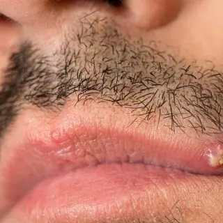 ingrown beard hair