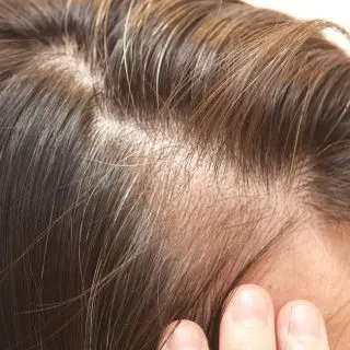 Is Dying Hair Bad for My Thinning Hair?
